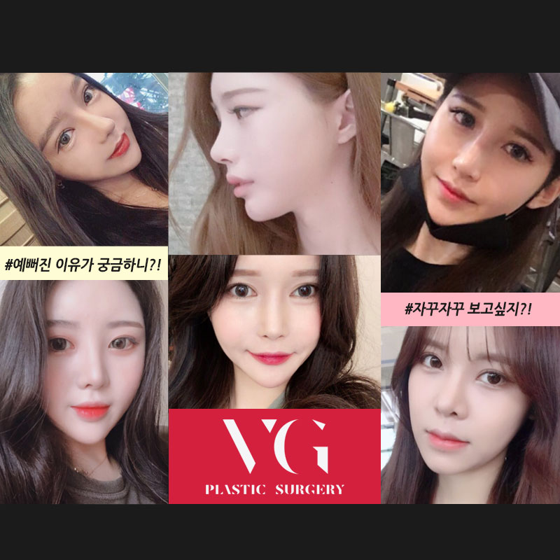 베리굿성형외과 트임성형! 내가 원하던 천사눈망울, 엔젤트임 김준현원장님 관련 이미지 8