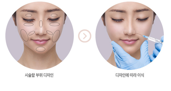 베리굿 걸을 위한 베리굿성형외과 PRP지방이식✨ 관련 이미지 6