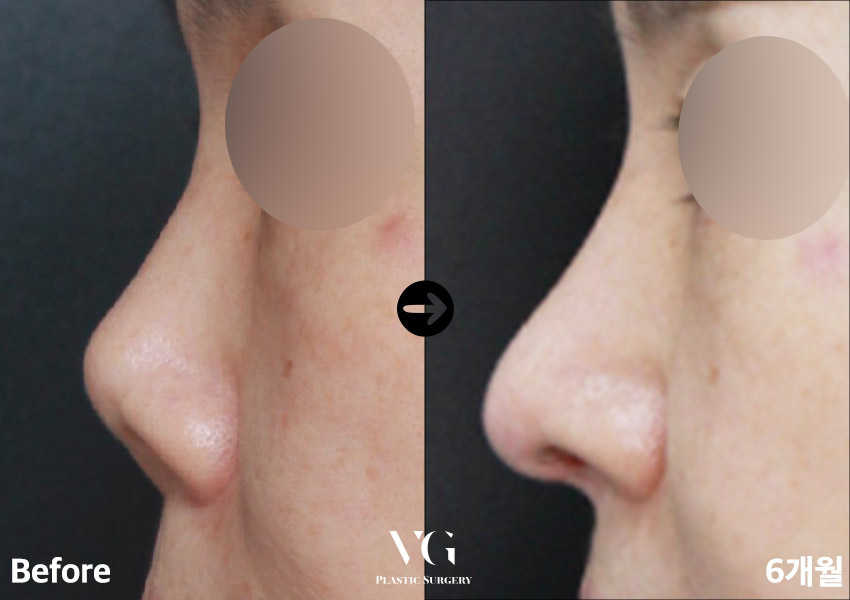 실패한 구축코재수술 베리굿에서 👨&zwj;⚕️✨ 관련 이미지 11