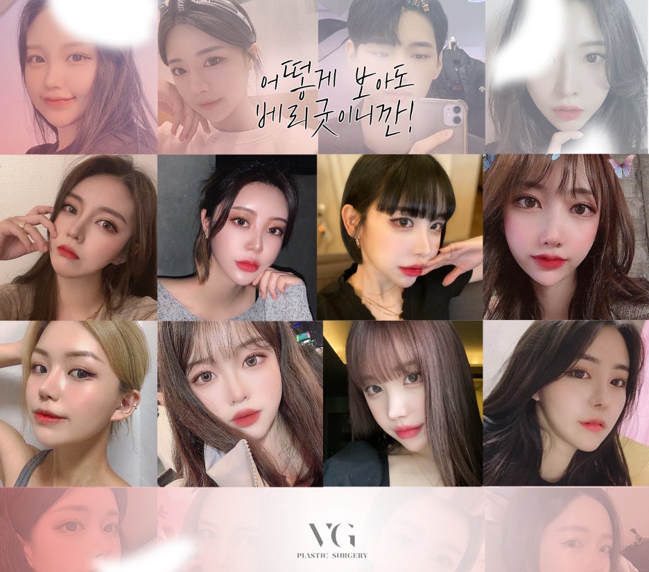 베리굿성형외과-MZ코,내돈 내산 코성형후기 mz세대의 유행하는 코성형은? 코성형부작용 1일차,3일차,1달차,전후후기 관련 이미지 18