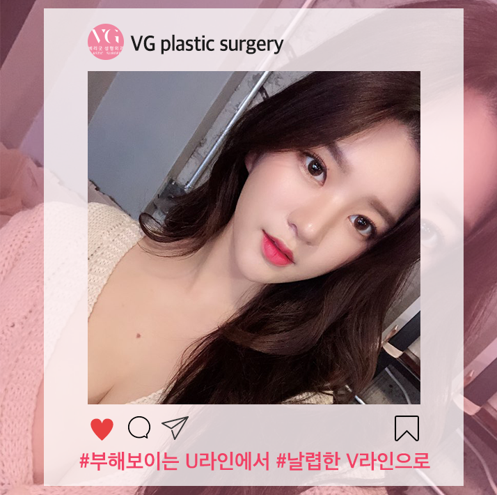 턱밑지방흡입 갸름하고 날렵하게 관련 이미지 1