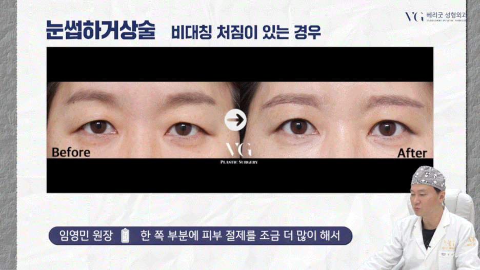 강남중년눈성형 잘하는곳 , 상안검 하안검 눈썹하거상술종류 진행방법 궁금하다면 관련 이미지 20