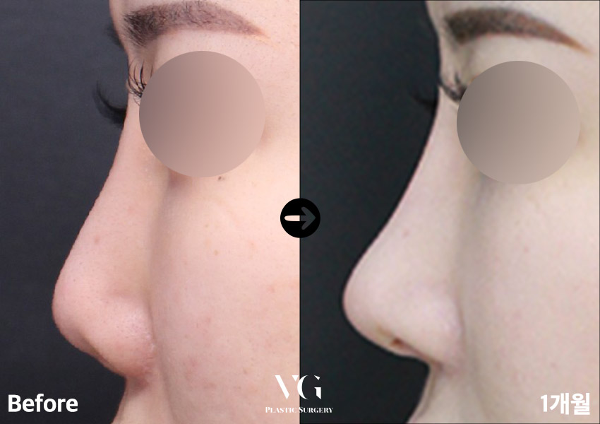 실패한 구축코재수술 베리굿에서 👨&zwj;⚕️✨ 관련 이미지 8