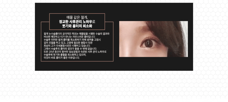 눈재수술도 베리굿하게😍베리굿성형외과 관련 이미지 5