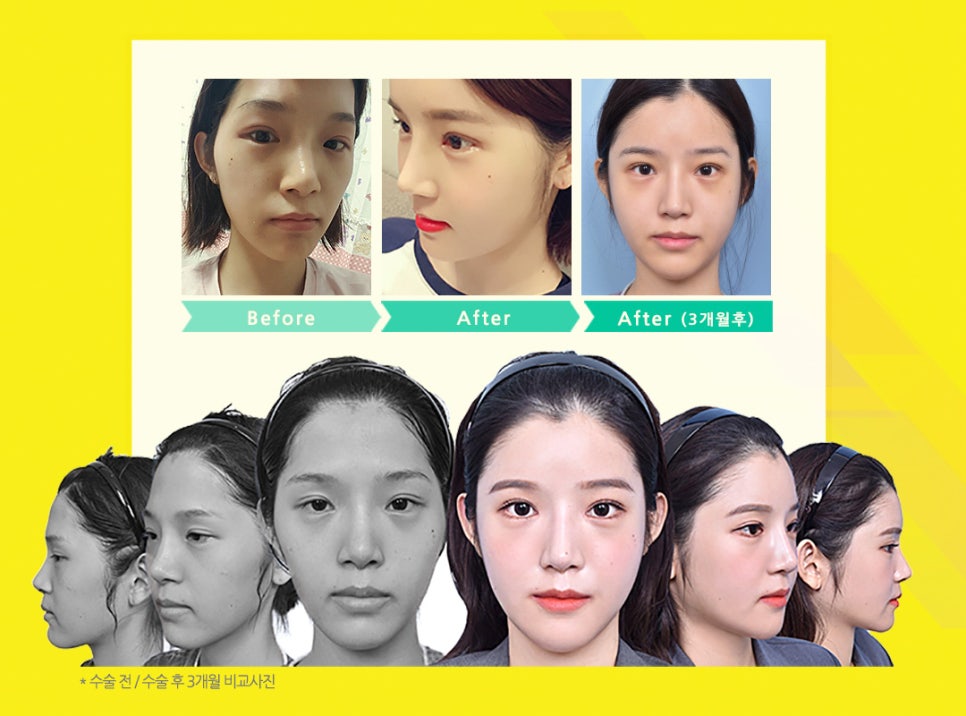 얼굴 작아지는법/ 베리굿성외과 3D광대축소술180만원 /강남역성형외과/강남역위치 관련 이미지 11