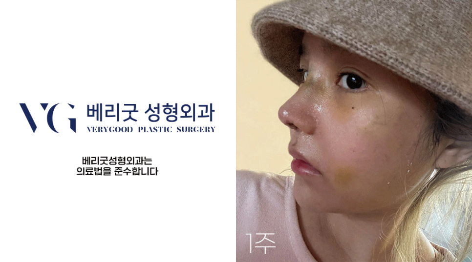 화려한 코라인, 베리굿성형외과 자가늑코성형✨ 관련 이미지 8