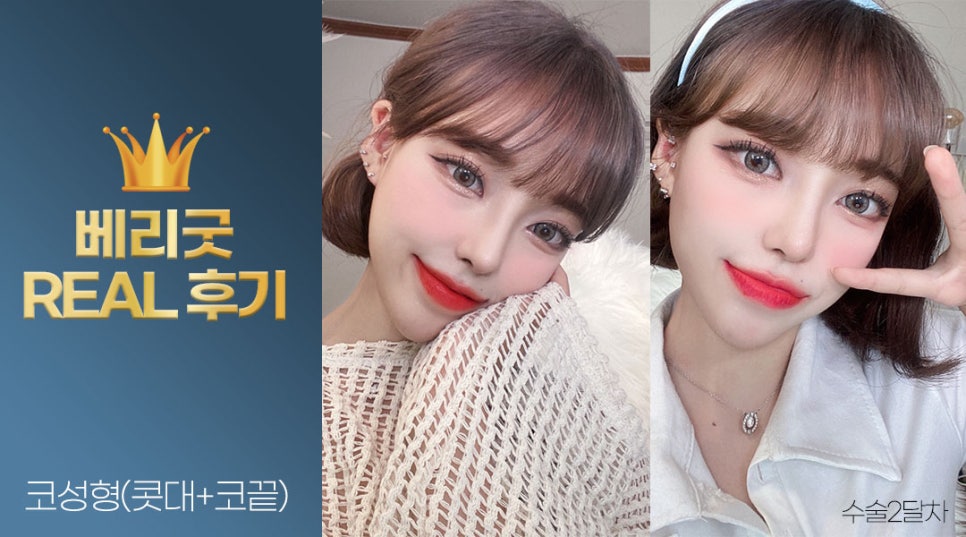 내가 예뻐진 이유❣ 베리굿성형외과 강남역 코성형 리얼후기✨ 관련 이미지 3