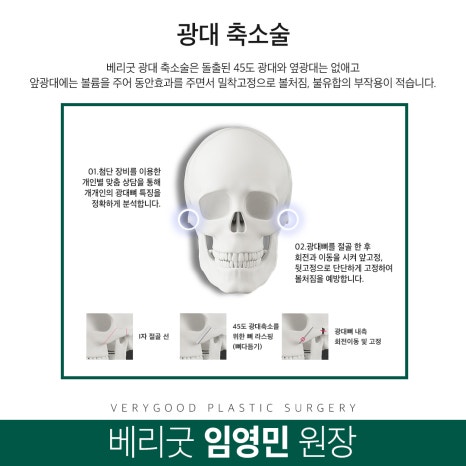 안면윤곽 어떤 종류가 있을까? 장점과 주의사항 알아보기 관련 이미지 5