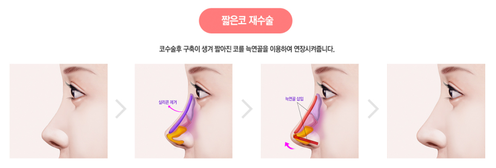 베리굿에서 자가늑연골로 베리굿하게 코수술하자💜 관련 이미지 5