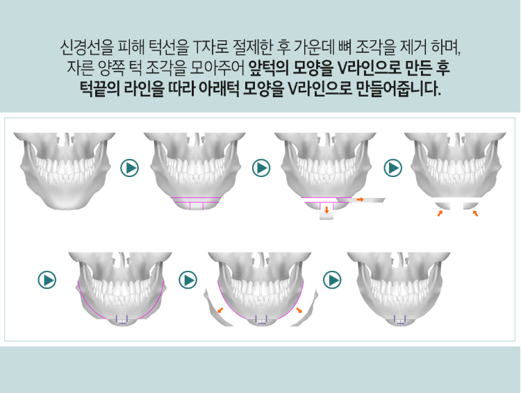안면윤곽의 모든것이 알고싶다면!! 관련 이미지 8