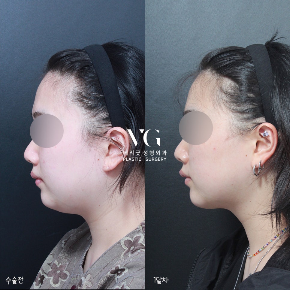 베리굿 얼굴지방흡입 전후💖밖에서 언제까지 마스크 쓸래? 관련 이미지 6