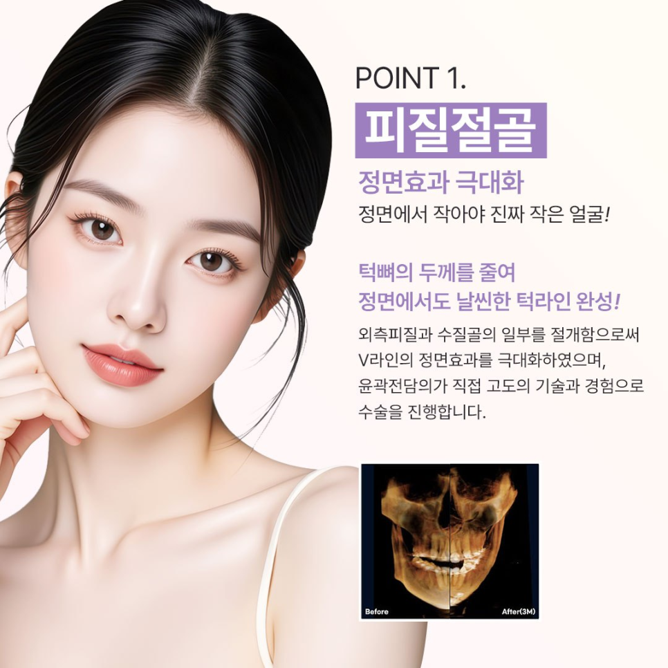 연예인 얼굴형 관리법 ? 요새 트렌드인 베리굿 성형외과 핀없는 안면윤곽 관련 이미지 3