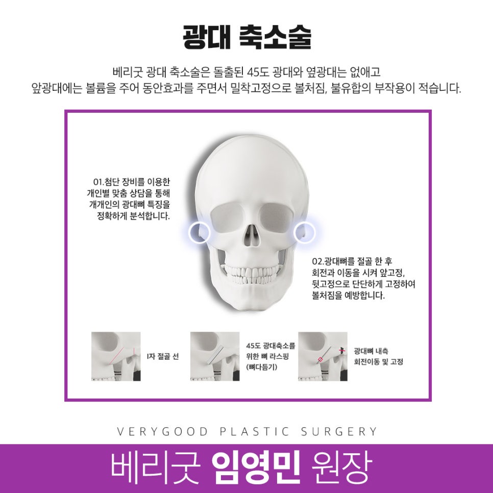 옆광대축소도 똑똑하게 알아보고 관련 이미지 5