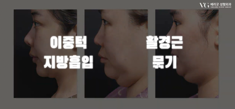 강남역 마녀턱 턱끝거상 , 리프팅원인 수술방법 총정리 관련 이미지 16