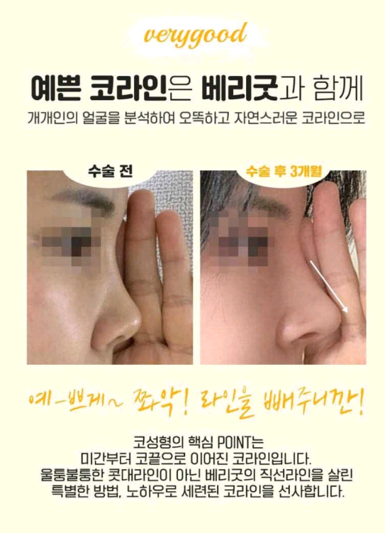 베리굿성형외과-MZ코,내돈 내산 코성형후기 mz세대의 유행하는 코성형은? 코성형부작용 1일차,3일차,1달차,전후후기 관련 이미지 9