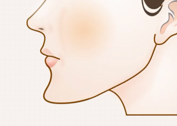 강남역 마녀턱 턱끝거상 , 리프팅원인 수술방법 총정리 관련 이미지 15