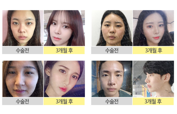 엑설런트코성형으로 콧대높은 자신감 얻자! 관련 이미지 10