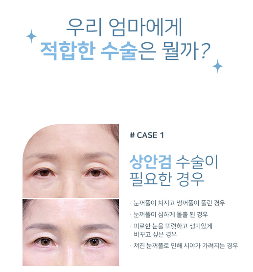 처진 눈꺼풀로 답답한 인상, 강남역 중년 눈성형으로 교정하기 관련 이미지 2
