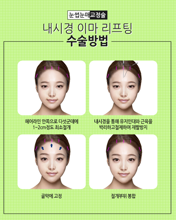 이마거상술로 깊은 이마주름과 처진 눈을 한번에~! 관련 이미지 7