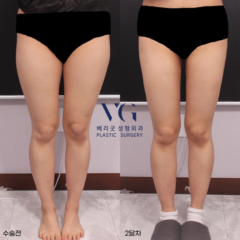 베리굿 몸매💖베리굿 허벅지 지방흡입 전후👙 관련 이미지 4