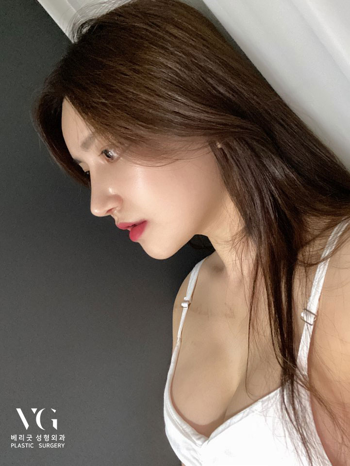 오똑하고 세련된 코라인 이젠 필러말고 코성형으로 확실하게! 관련 이미지 2