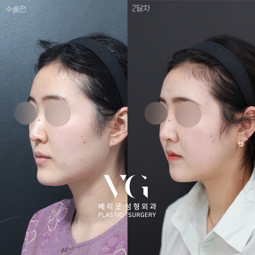 [베리굿성형외과]윤곽수술+코성형 REAL전후💖💖 관련 이미지 1