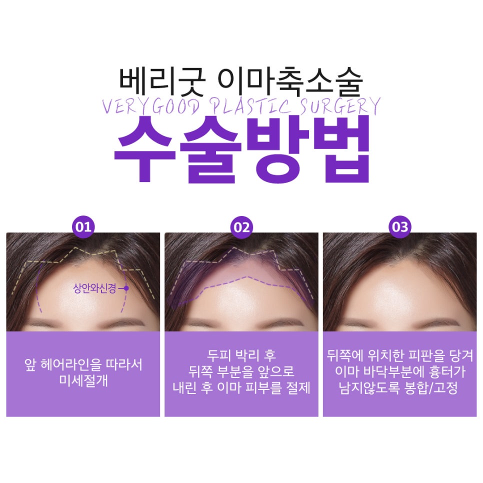 이마축소로 이상적인 이마라인 만들자! 관련 이미지 4
