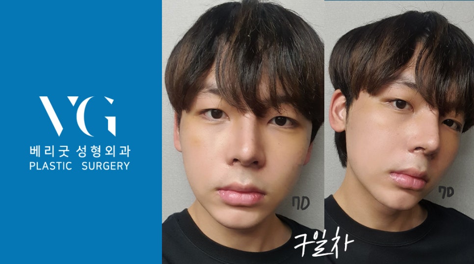 남자인생코 맛집 베리굿성형외과 리얼스토리💌 관련 이미지 3