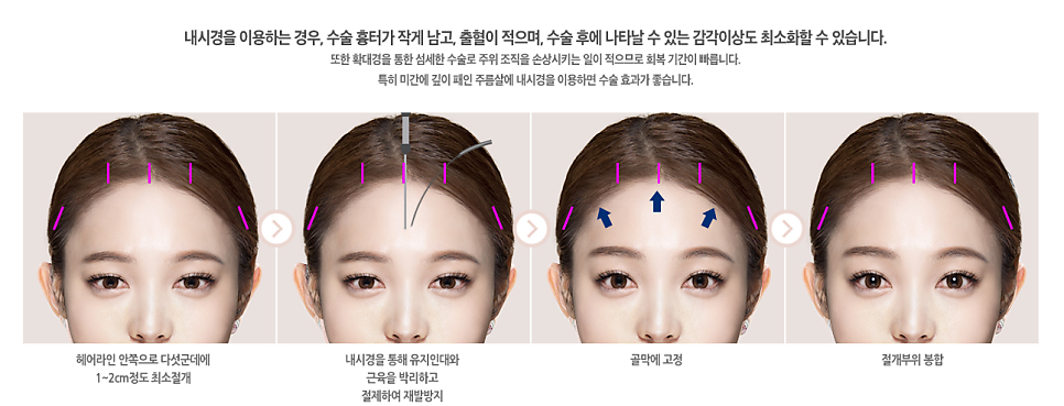 강남역 이마거상 전후, 베리굿성형외과💖 관련 이미지 2