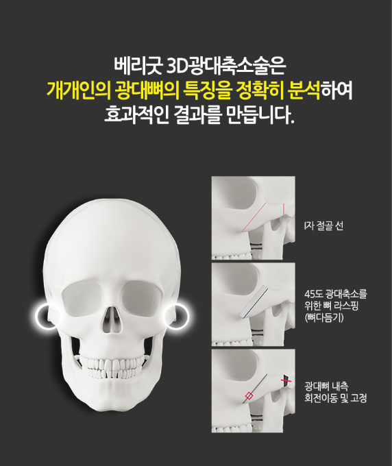 광대축소술 이젠 가리지말고 당당하게! 관련 이미지 3