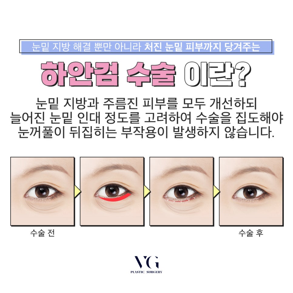 화사하고 동안 눈밑을 만들어주는 애교하안검 관련 이미지 4