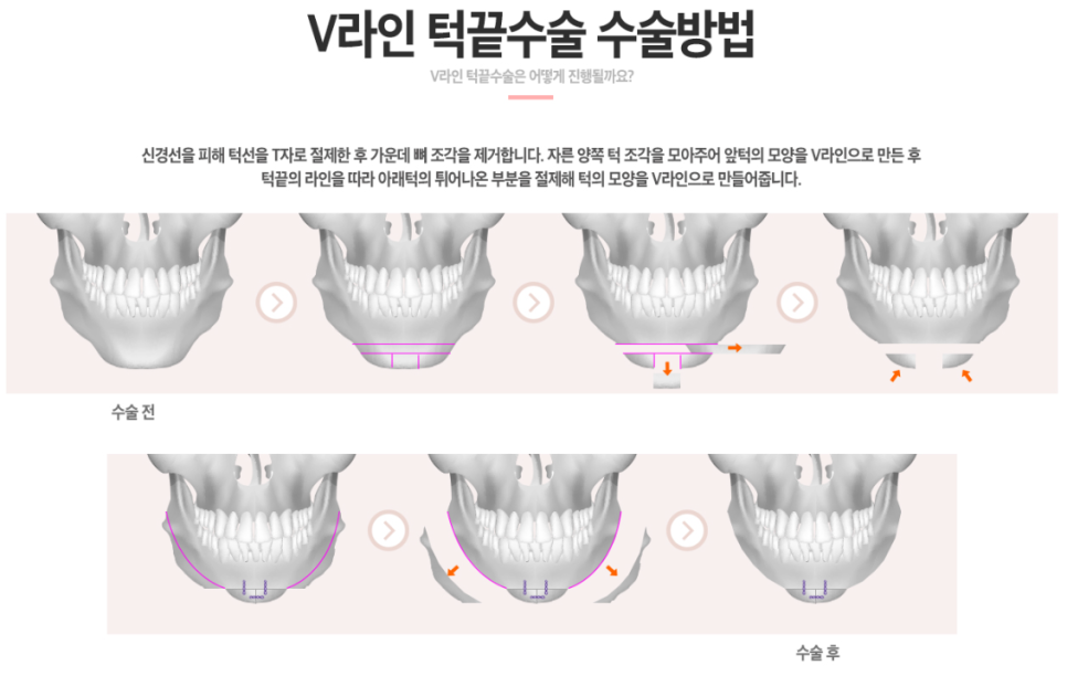 자연스러운 턱끝수술로 V라인 만들기 관련 이미지 3