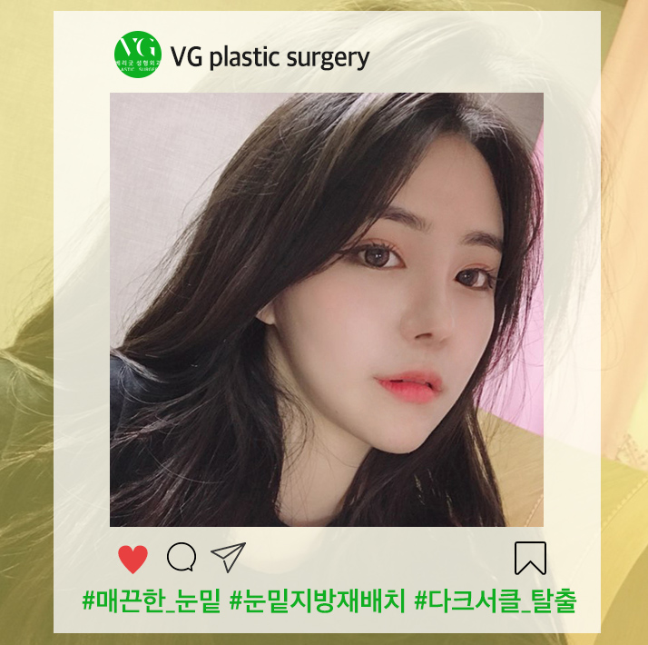 눈밑지방재배치수술로 팬더탈출! 재발없는 수술하는법? 관련 이미지 1