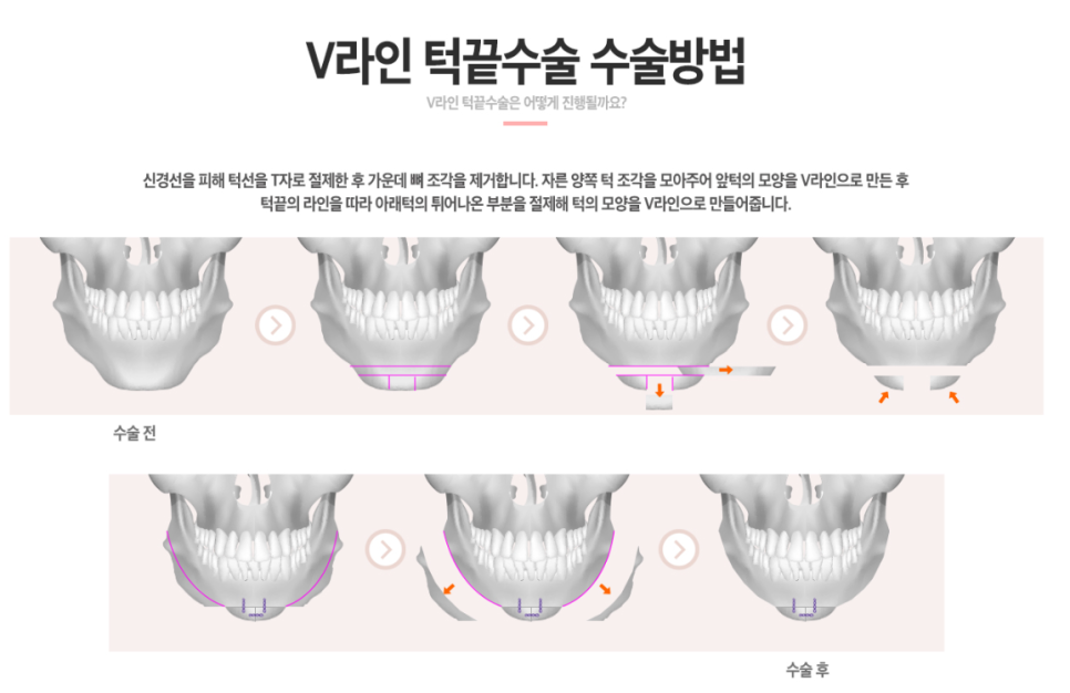 [베리굿성형외과]안면윤곽 리얼전후! 관련 이미지 17
