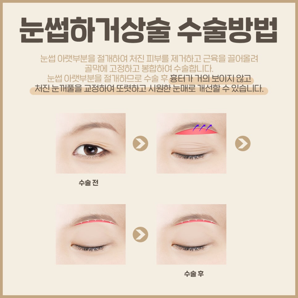40, 50대 처진 눈꺼풀, 베리굿 눈썹하거상술로 탱탱하게 개선하자! 관련 이미지 3