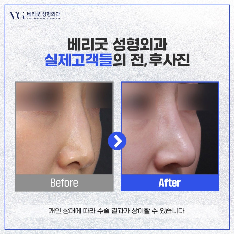코수술 후기 모음 zip. #1｜베리굿성형외과 8월 코성형 주간지 관련 이미지 2