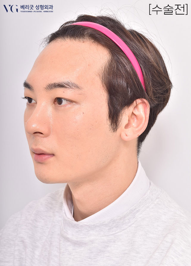 [베리굿성형외과]안면윤곽 리얼전후! 관련 이미지 10
