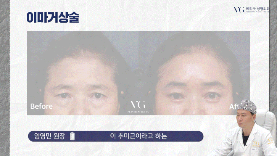 강남중년눈성형 잘하는곳 , 상안검 하안검 눈썹하거상술종류 진행방법 궁금하다면 관련 이미지 39