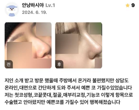 Primary Rhinoplasty, Osteotomy, Hump Correction, Septoplasty, Inferior Turbinate Resection | 베리굿성형외과 Before-and-After Review image 5