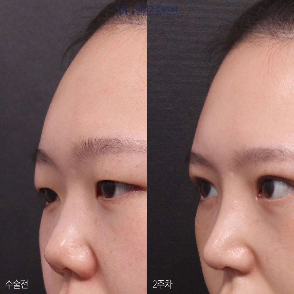 직반코성형? 베리굿성형외과💙 화려하게,자연스럽게✨ 관련 이미지 4