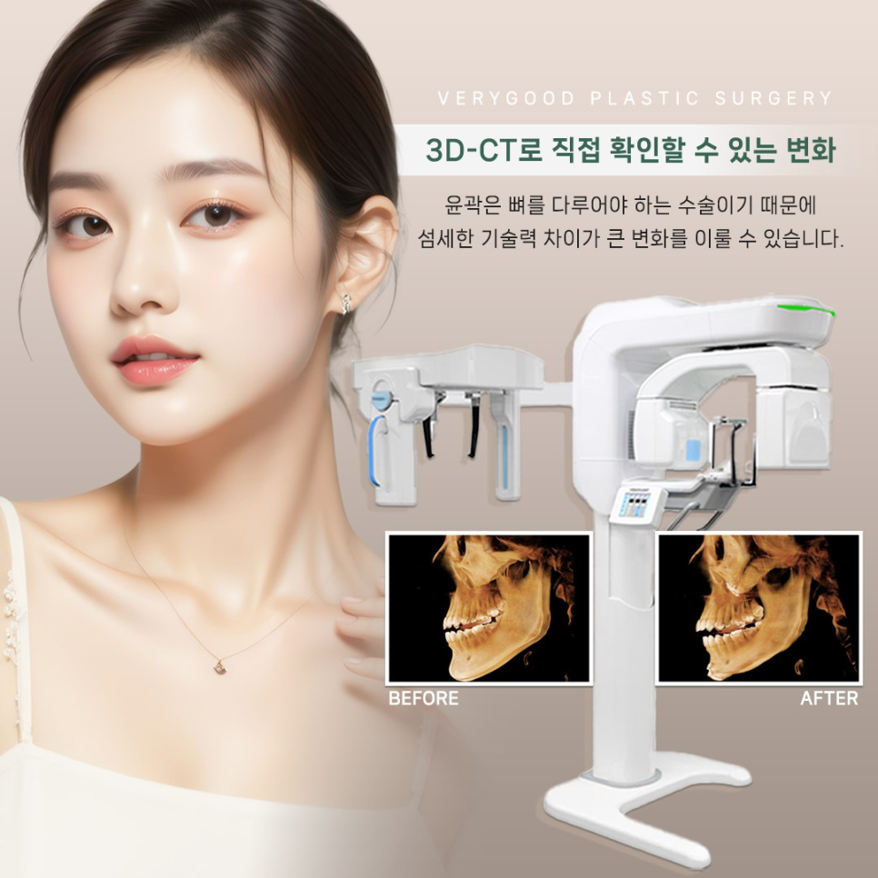 강남 광대축소술, 얼굴 라인을 바꾸는 자연스러운 윤곽 개선 방법 관련 이미지 4