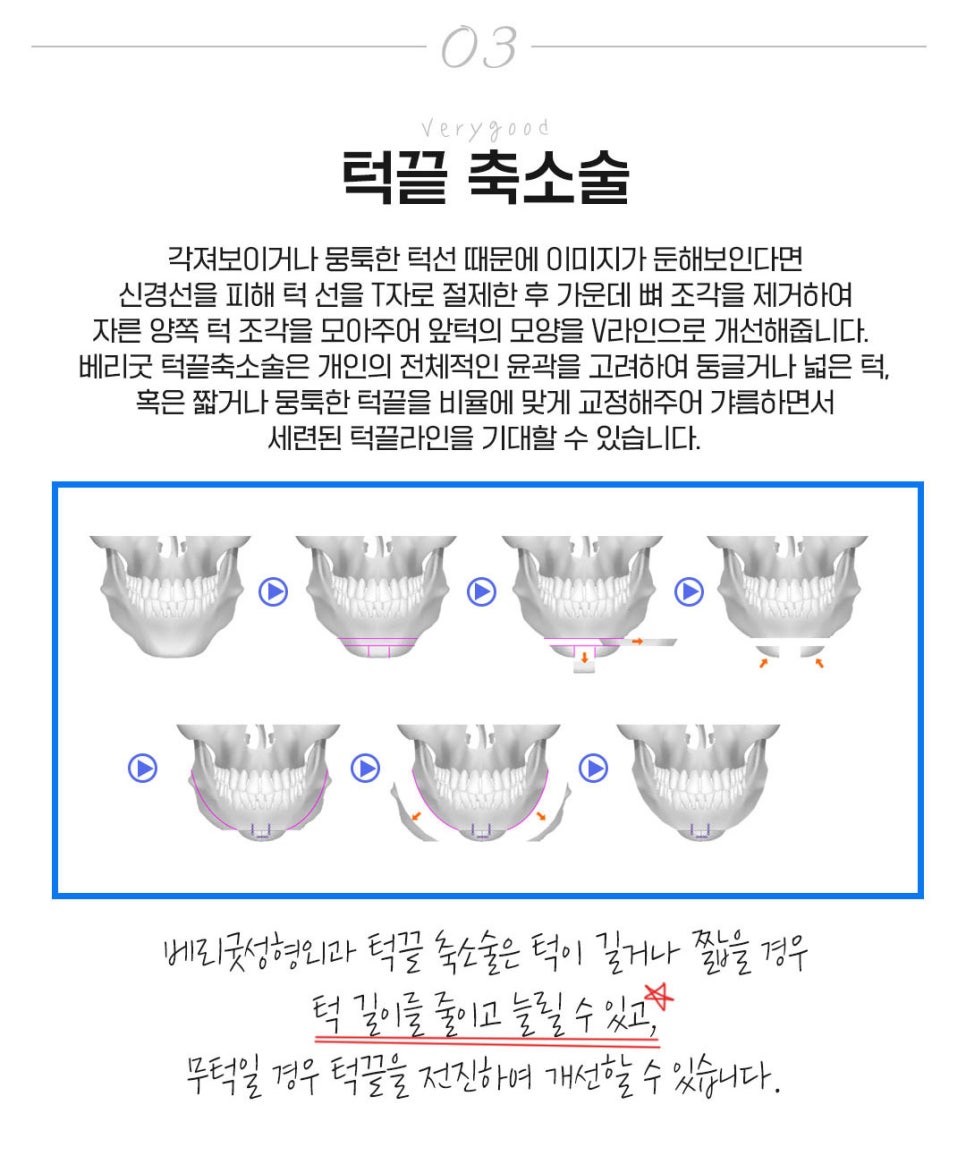 강남역광대축소 베리굿성형외과💜 관련 이미지 7