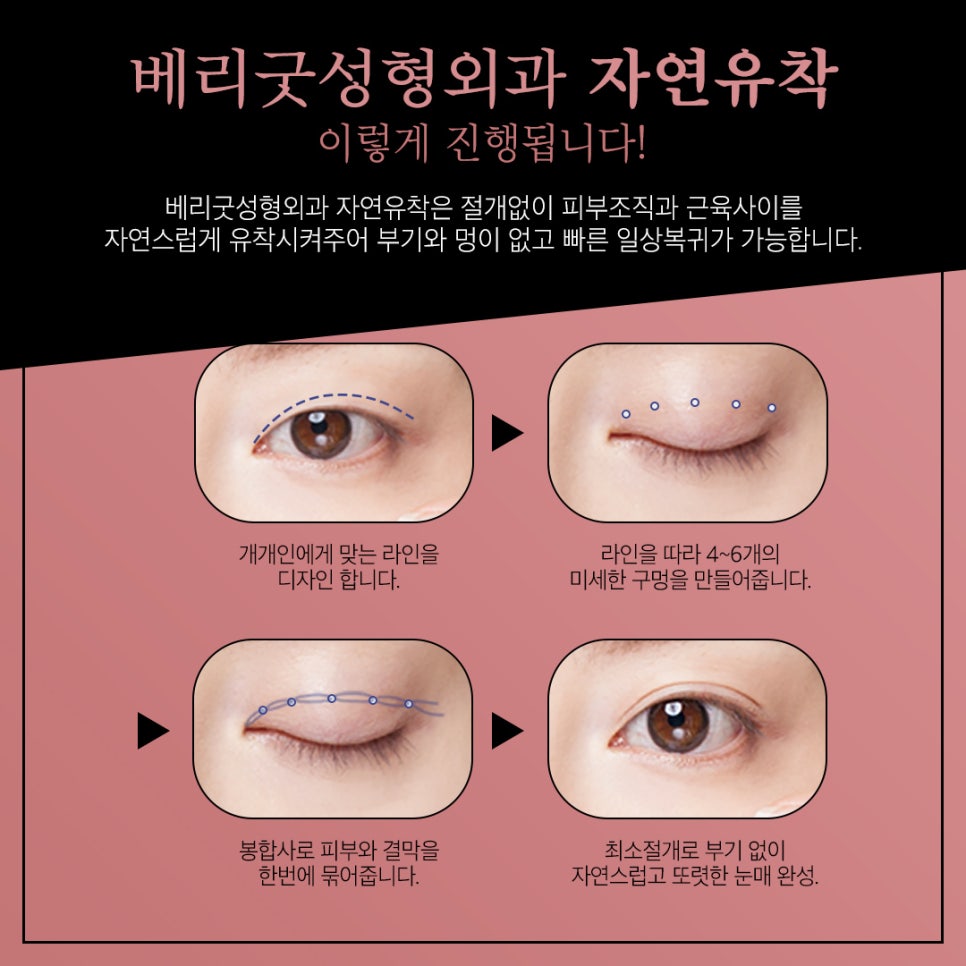 자연유착 쌍꺼풀수술, 마치 내 것 같은 자연스러움 관련 이미지 5