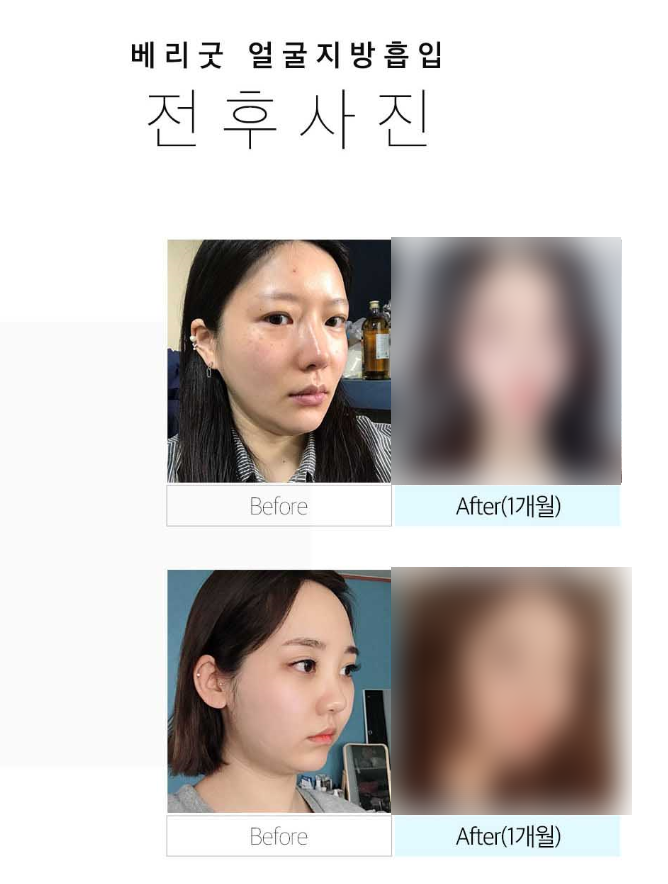 윤곽없이 v라인 얼굴지흡으로 완성! 관련 이미지 8