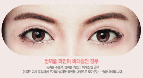 눈재수술, 원인과 상태에 따라 방법도 바뀐다? 관련 이미지 8