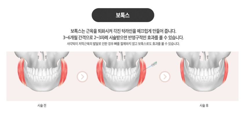 사각턱축소술 이젠 가리지말고 당당하게! 관련 이미지 4