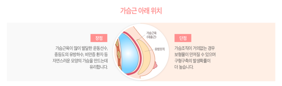 가슴성형 1탄! 가슴성형후기 보형물 부터 수술방법까지 꼼꼼하게 알아보자! 관련 이미지 5