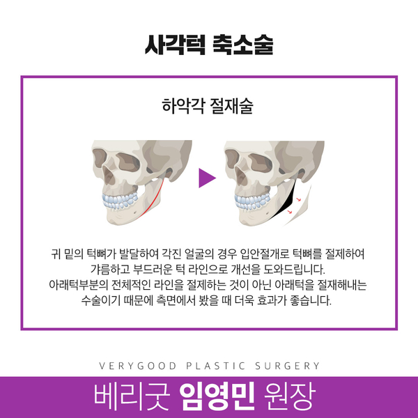 사각턱축소술 수술방법부터 주의사항까지 확실하게 관련 이미지 9