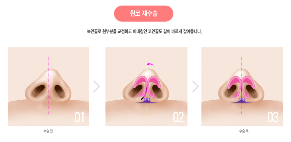 자가 늑연골 코재수술로 완벽해지자! 관련 이미지 3