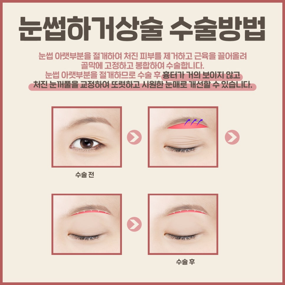 효도수술인 눈썹거상술, 어떻게해야 성공적일까? 관련 이미지 6